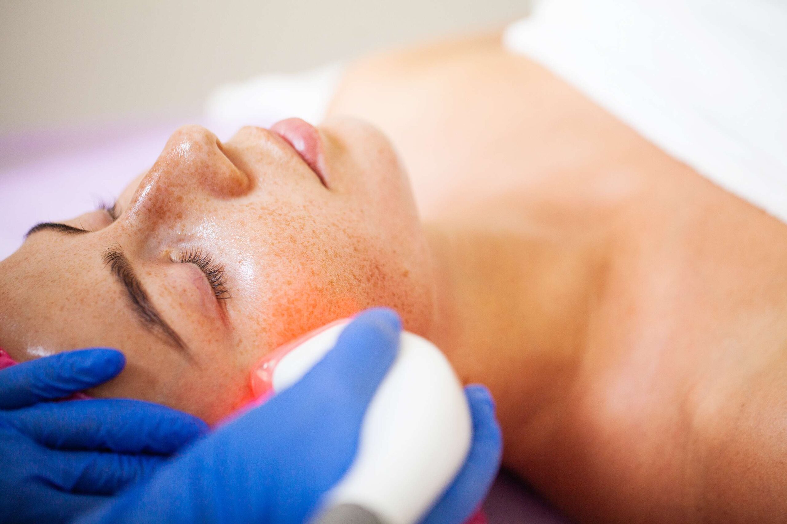 La lumière intense pulsée est-elle efficace pour les rougeurs ?